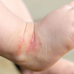 7 Tips to Manage Eczema Without Seeing a Dermatologist