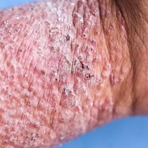 Solutions for Severe Eczema