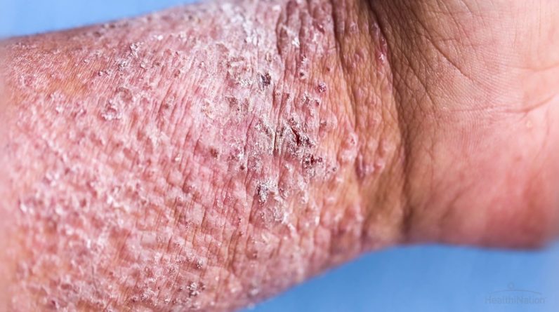 Eczema Bubbles Under The Skin Painful Pus Filled Skin
