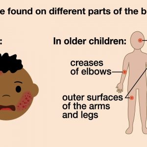 Signs of Eczema in Children