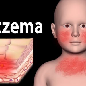 Eczema inflammation of the skin