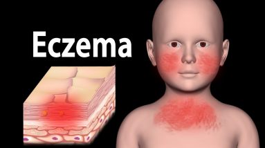 Eczema inflammation of the skin