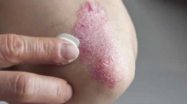 Where eczema occurs on the body