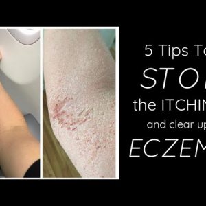 Stop the eczema itch