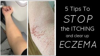 Stop the eczema itch
