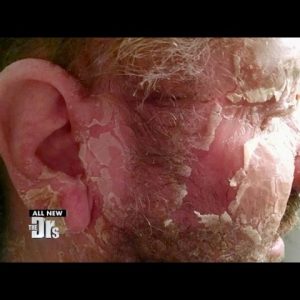 Extreme Eczema of the face