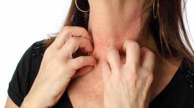 Myths about Eczema
