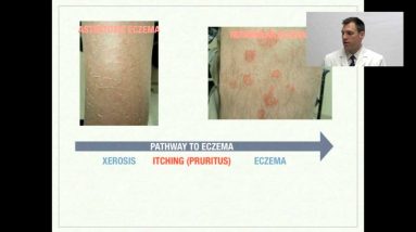 Dry Skin and Eczema Treatment - OnlineDermClinic