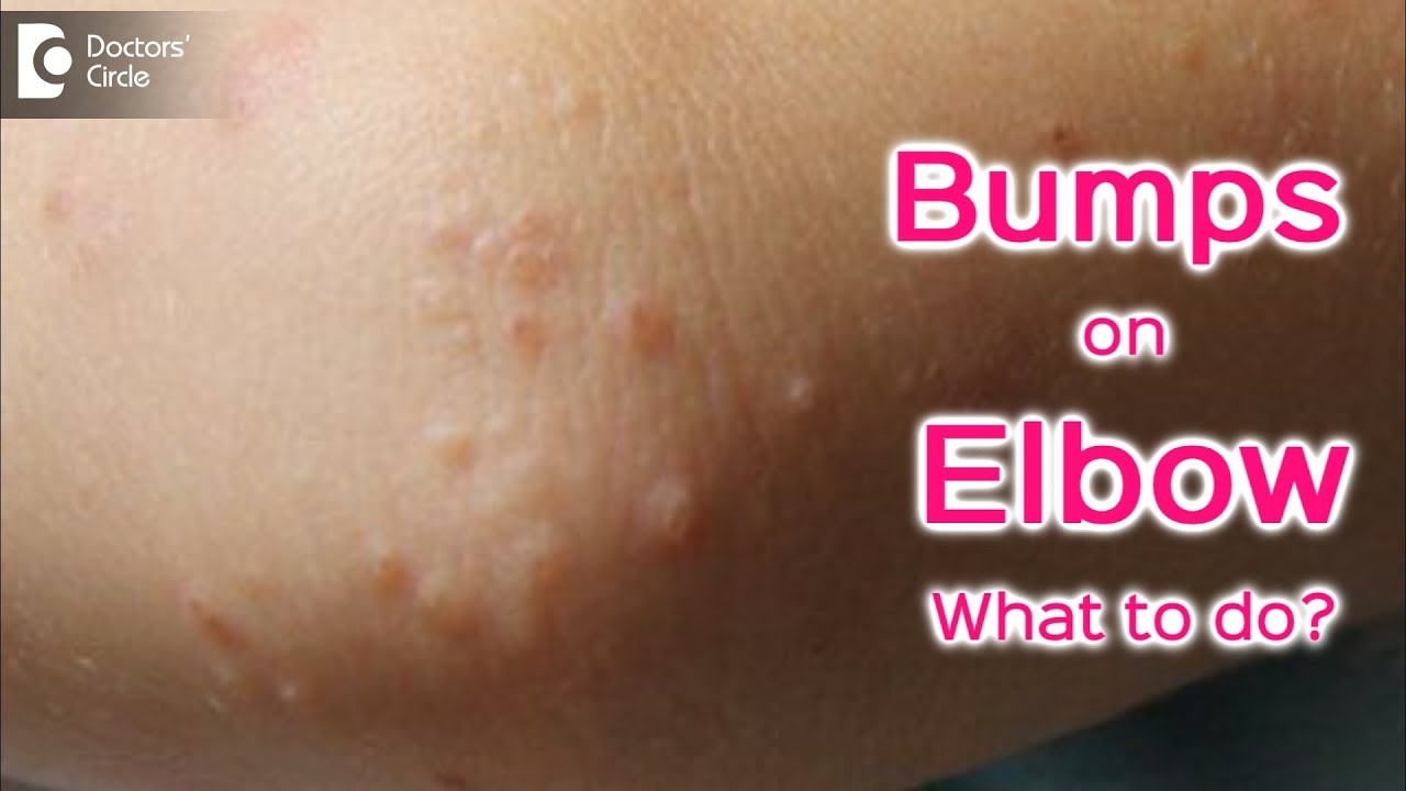 Small Raised Bumps On Elbow Causes And Treatment Dr Rajdeep Mysore