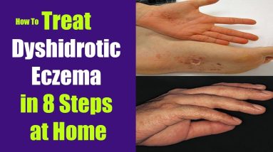 How to Treat Dyshidrotic Eczema in 8 Steps at Home 10 1680273982 maxresdefault