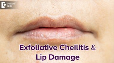 Exfoliative Cheilitis & its effect on Lips | DRY LIPS-Best Treatment-Dr.Rasya Dixit| Doctors' Circle 8 1680274231 maxresdefault