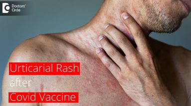 URTICARIAL RASH AFTER COVID VACCINE | How long does it last? - Dr. Surekha Tiwari | Doctors' Circle 16 1680278839 maxresdefault