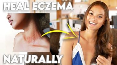 How to TREAT ECZEMA (and what causes it!) 12 1680279118 hqdefault