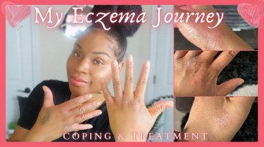 How I’m Getting My Chronic Eczema Under Control: Dupixent Journey | First Injection + 2 Week Update 4 1680282811 maxresdefault
