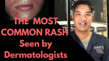 How to treat Perioral Dermatitis- Dermatologist Explains 2 1680282905 maxresdefault
