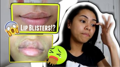 CONTACT DERMATITIS ON LIPS! | What my Doctor Prescribed 👩⚕️ 8 1680287811 maxresdefault