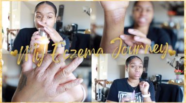 My Eczema Journey UPDATE : Back to the Basics! | Coping & Life without Dupixent | Jess4TV 16 1680291562 maxresdefault