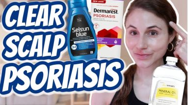 How to CLEAR SCALP PSORIASIS| Dr Dray 14 1680291992 maxresdefault