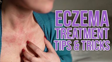 Eczema Treatment Tips & Tricks 20 1680302145 maxresdefault