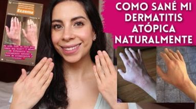 Como Sané mi Dermatitis Atópica sin Medicamentos y de Forma Natural! 14 1680302626 hqdefault