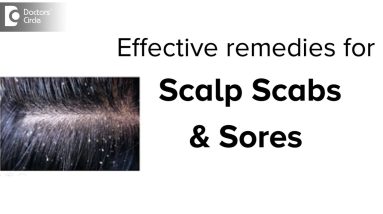 Scabs & Sores on Scalp: Treatment, Causes & Remedies - Dr. Aruna Prasad 12 1680303362 maxresdefault