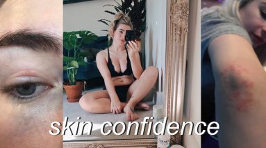 AD | MY TIPS ON FEELING CONFIDENT IN YOUR SKIN | LIVING WITH ECZEMA 6 1680305820 maxresdefault