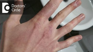 Causes of black spots, cuts & itching on fingers-Dr. Aruna Prasad 4 1680311394 maxresdefault