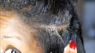 Warning-GROSS! Extreme ECZEMA attack on my scalp. How I recovered 18 1680318732 maxresdefault