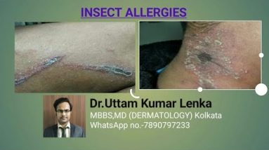 Insect Allergy/eczema/blister beetles dermatitis (Rat me kida chadhne Se allergy)- Dr. Uttam K Lenka 16 1680318959 hqdefault