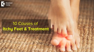 10 CAUSES OF ITCHY FEET: How to get relief ? Right Treatment - Dr. Urmila Nischal |Doctors' Circle 2 1680322609 maxresdefault