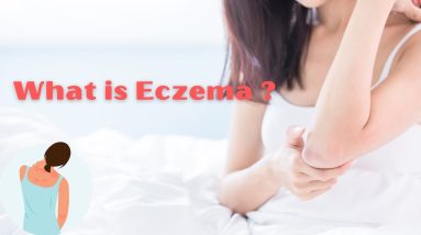 What is Eczema ? 12 1680325478 maxresdefault