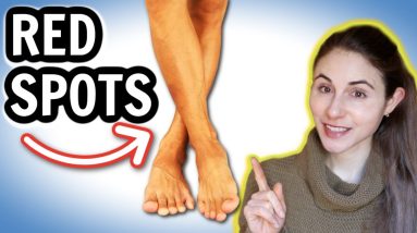 Why you get RED SPOTS ON THE LEGS & HOW TO GET RID OF THEM // Dermatologist @DrDrayzday 8 1680326380 maxresdefault