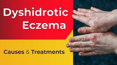 What is Dyshidrotic Eczema? - Overview, Causes, Treatments 20 1680329142 maxresdefault