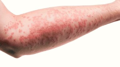 What is Cell Phone Dermatitis? - Dr. Amee Daxini 18 1680329283 maxresdefault