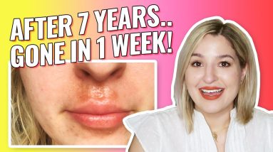 How I Cured My Eczema, Cheilitis, Contact Dermatitis Lip Rash Once & For All after 7 Years 16 1680329837 maxresdefault
