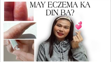 HAND ECZEMA TREATMENT IN EFFECTIVE WAYS|ALGEN'S VLOGGS 14 1680330133 maxresdefault