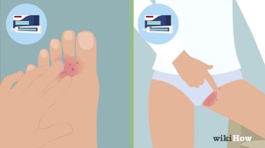 How to Cure Jock Itch 20 1680333960 maxresdefault