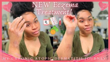My *NEW* Eczema Journey: Atopic Dermatitis Treatment | 1 Week Update + Pros & Cons of New Meds! 8 1680337157 maxresdefault