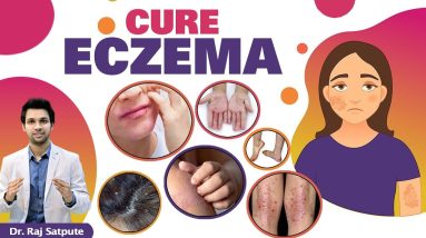 NO MORE ECZEMA | Get Rid of Itching & Eczema Naturally & Permanently At Home | Eczema Best Treatment 2 1680339274 maxresdefault