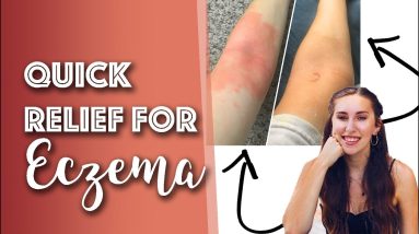 How to reduce eczema in 3 hours! | WHAT WORKS? 20 1680339702 maxresdefault