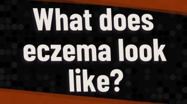 What does eczema look like? 12 1680341401 maxresdefault