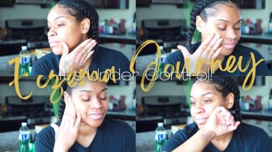 I FINALLY Got My ECZEMA Under Control! | How To Treat Eczema + LUXE Skincare | Jess4TV 20 1680345025 maxresdefault