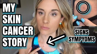 MY SKIN CANCER STORY - MY SIGNS AND SYMPTOMS! 4 1680349608 maxresdefault