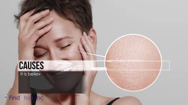 What Is Seborrheic Dermatitis? 14 1680352597 maxresdefault