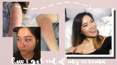 HOW I GOT RID OF ECZEMA | NUMMULAR 12 1680352921 maxresdefault