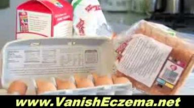 The Pros and Cons of Treating Eczema in Children Using Natural Remedies 6 1680354054 hqdefault