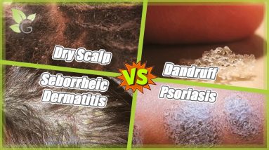 Dry Scalp -vs- Dandruff -vs- Seborrheic Dermatitis -vs- Psoriasis 4 1680354473 maxresdefault