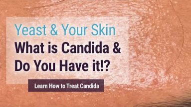 Yeast affecting your skin? You may have it and not know! (Candida Albicans) 18 1680367977 hqdefault