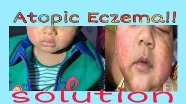 Eczema in children (Atopic Eczema) Cause, diagnosis, prevention and treatment- Dr. Uttam K. Lenka 10 1680371907 maxresdefault