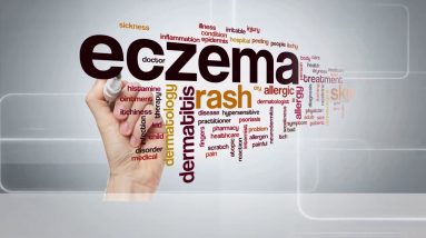 How to treat your Eczema Hyperpigmentation 8 1680372376 maxresdefault